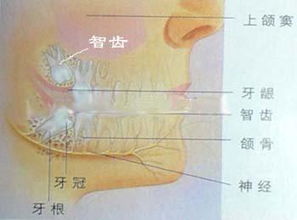 牙齿矫正存在智齿需不需要拔掉 