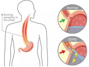 觉下咽困难是怎么回事 胃食管反流病一般多久能治愈