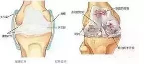 得了肾结石 骨质增生能不能补钙 看专家怎么说