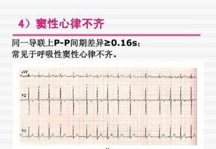 今天到医院体检 做了个小型心电图 大夫说心率快建议做一次全面检查 心率快是怎么回事严重嘛