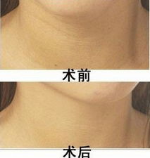 消除颈纹 如何消除颈纹最有效的方法