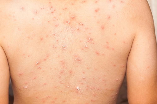 长春肤康医院浅谈 急性荨麻疹与慢性荨麻疹哪一种更为严重
