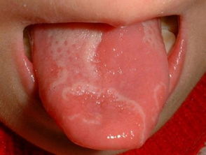癌 初期 舌