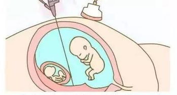多胎妊娠的临床表现，多胎妊娠什么意思