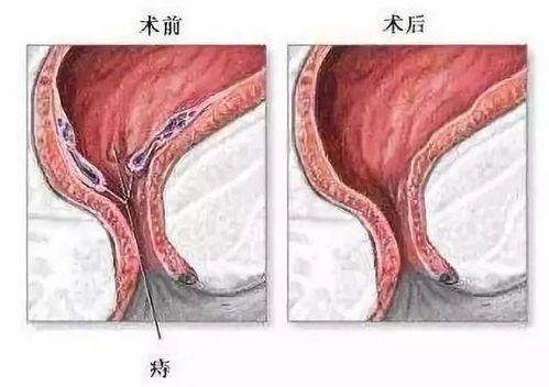 有了痔疮是否应该动手术割掉