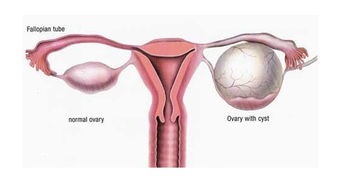 原创卵巢囊肿切除你必须明白这些