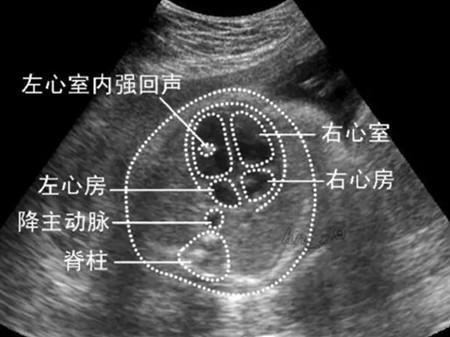 产检胎儿左心室有强光点 别慌,原来跟心脏无关