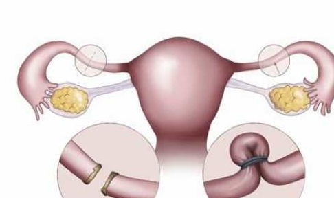 女性结扎有好有坏 别被骗了,根本没有好处