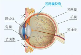 视网膜脱落原因，视网膜脱落的原因是什么