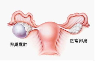 卵巢囊肿的表现有哪些呢