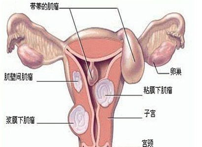 子宫囊肿是什么原因引起的啊