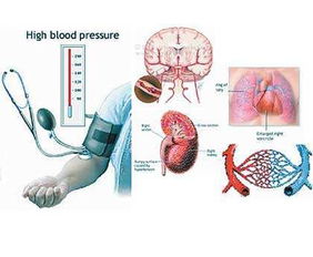 高血压偏爱人群,看看你中招了没有 