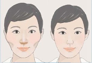 改脸型手术的方式有哪几种？价格分别是多少钱？