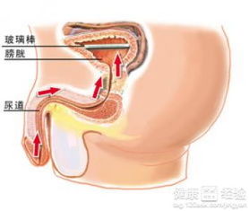 输尿管结石碎石前一定要做肾造影吗