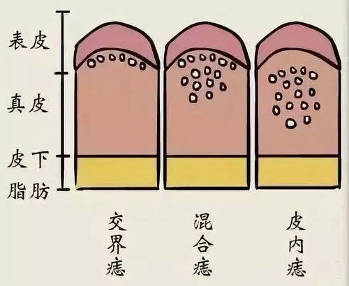 痣里面硬硬的按起来有点痛