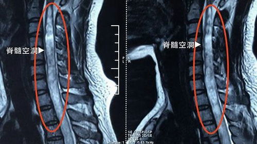 德胜门殷世荣主任 脊髓空洞症的症状表现都有什么呢 应该注意什么