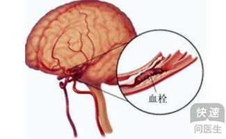 脑血栓最常见的临床症状有哪些