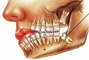 为什么医生一定要让你拔智齿 你不知道的真相