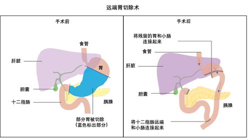 胃癌,如果把胃全部切除,能活多久 