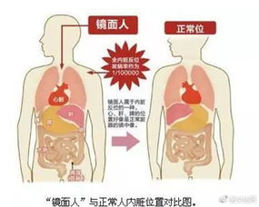 镜面人 全腹部脏器反位生存76年,罕见