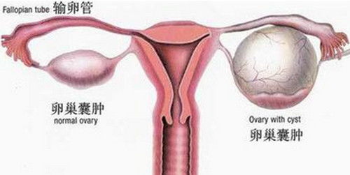 卵巢囊肿对促排和移植有什么影响?