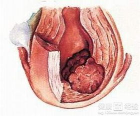 侵蚀性葡萄胎属于癌证吗