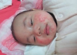 一个月婴儿下巴长满湿疹,一个多月宝宝脸上长湿疹怎么办？