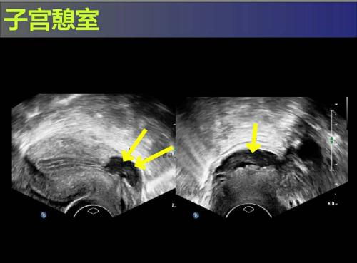 子宫憩室的最严重症状 我剖腹产三胎，子宫憩室怎么办？要做手术吗？ 