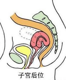 子宫后位影响怀孕吗,子宫后位影不影响怀孕