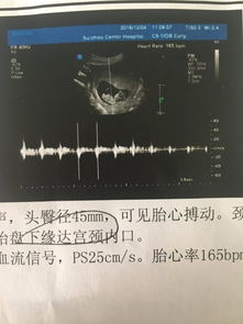 我是11周去医院做的NT图,图如下,请看一下男女 