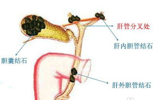 胆结石吃了金胆片不疼了，是不是就不用手术了(金胆片对胆囊结石有用吗)