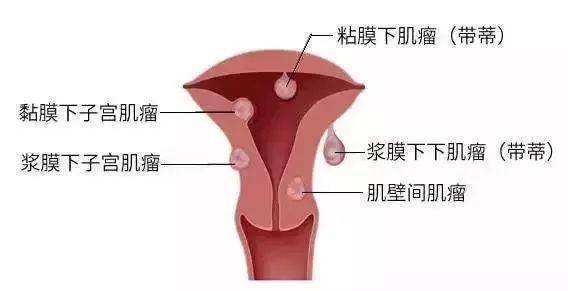 什么是子宫肌瘤？子宫肌瘤如何影响试管结果？