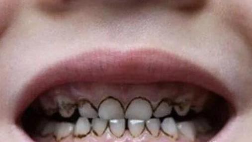 蛀牙为什么是黑色的(为什么蛀牙会变黑色)
