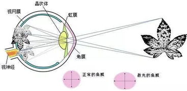 形成散光的原因是什么