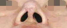 隆鼻综合手术后,鼻孔会不会出现轻微不对称 原创