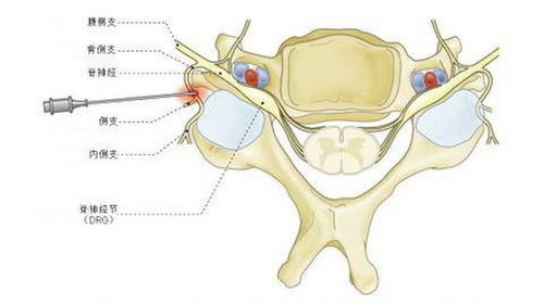 剖析脊髓型颈椎病手术后恢复过程