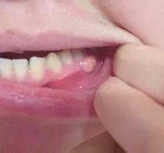 牙龈上的白色脓包能弄破吗因为不知道是什么东西来的啊