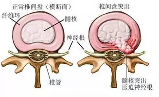 腰椎间盘突出症,不想手术 约90 可以保守治疗好