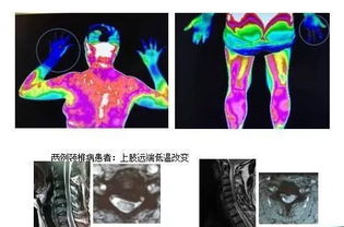 红外线热成像全身扫描