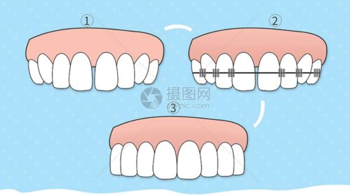 牙齿正畸过程中会损伤牙周吗