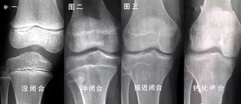 当年花16万断骨,只为长高7.2厘米的李亚诺,如今与后遗症为伴