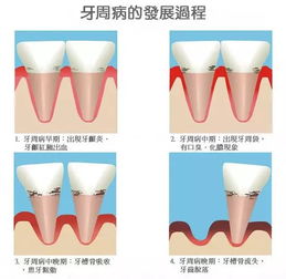 惊 刷牙经常出血千万不要以为只是上火 这是身体在报警