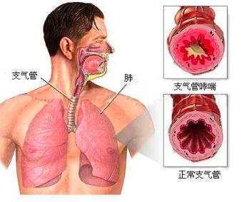 支气管哮喘保险有必要买吗,哮喘能买百万医疗险吗?