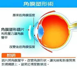 315晚会上曝光的 OK镜 到底是近视防控神器还是毁眼利器 