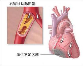 心脏搭桥有哪些并发症