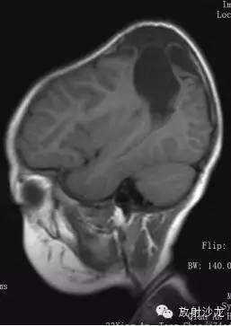 颅脑损伤后遗症 脑损伤可导致的疾病有哪些？ 