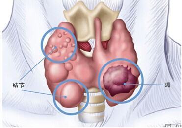 甲状腺癌的4大晚期症状有这些 再不知道就晚了 