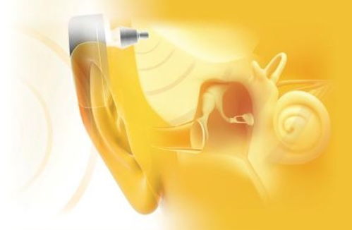 骨锚式助听器 BAHA 知多少