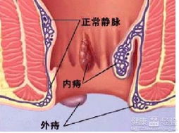 治疗痔疮不用药,只用小偏法就能治大病