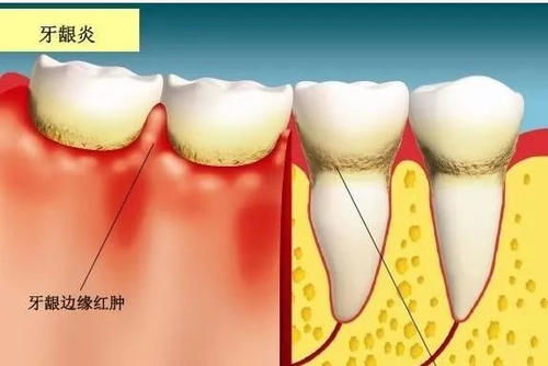 牙龈上长小脓包是怎么回事